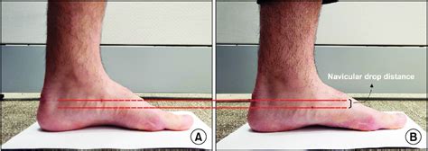 the navicular drop test|navicular drop test article.